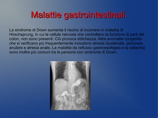 Malattie gastrointestinaliMalattie gastrointestinali
La sindrome di Down aumenta il rischio di incorrere in malattia di
Hirschsprung, in cui le cellule nervose che controllano la funzione di parti del
colon, non sono presenti. Ciò provoca stitichezza. Altre anomalie congenite
che si verificano più frequentemente includono atresia duodenale, pancreas
anulare e atresia anale. La malattia da reflusso gastroesofageo e la celiachia
sono inoltre più comuni tra le persone con sindrome di Down.
 