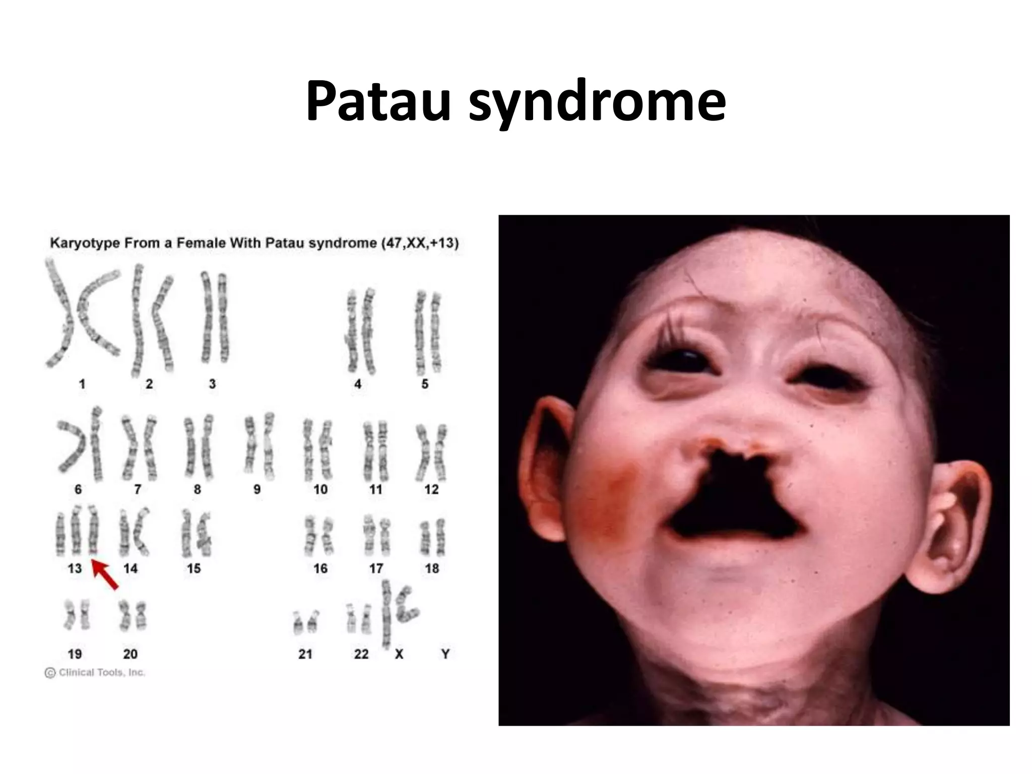 Patau syndrome
 