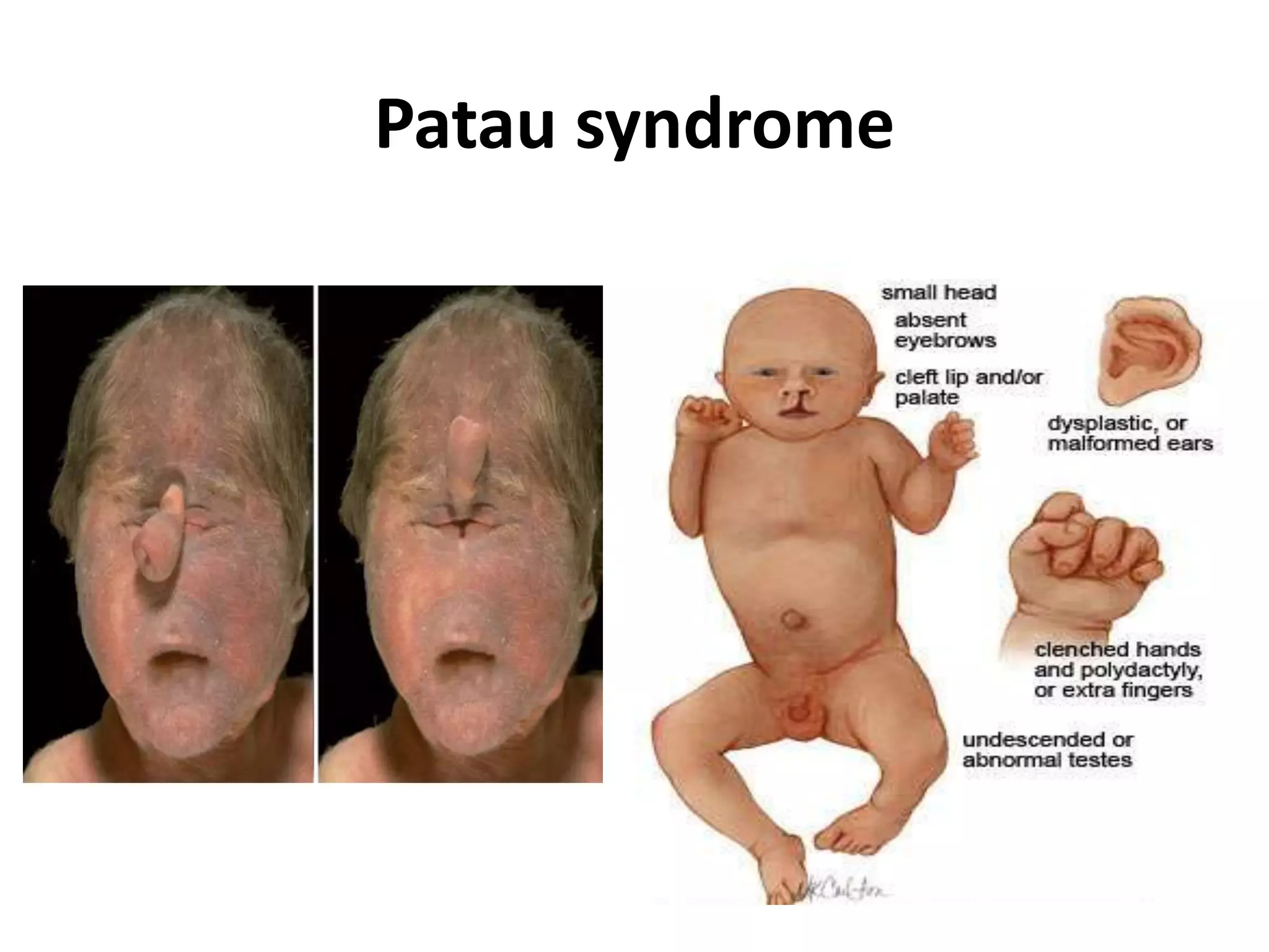 Patau syndrome
 