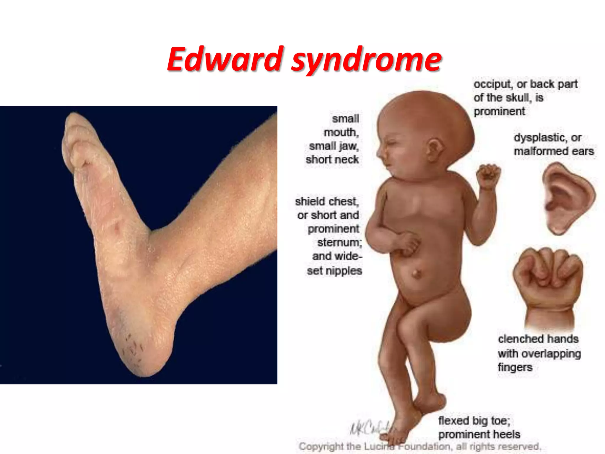 Edward syndrome
 