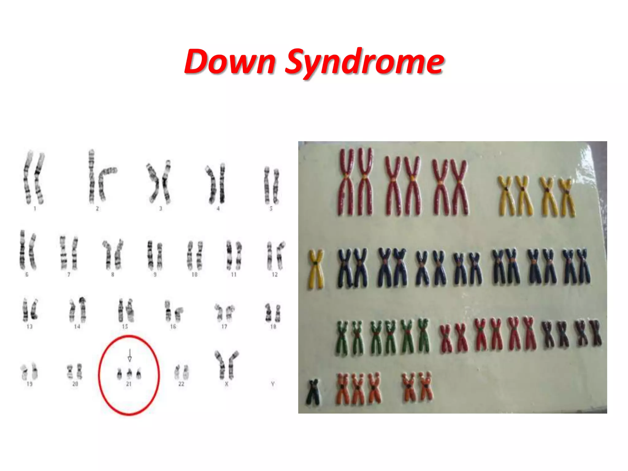Down Syndrome
 