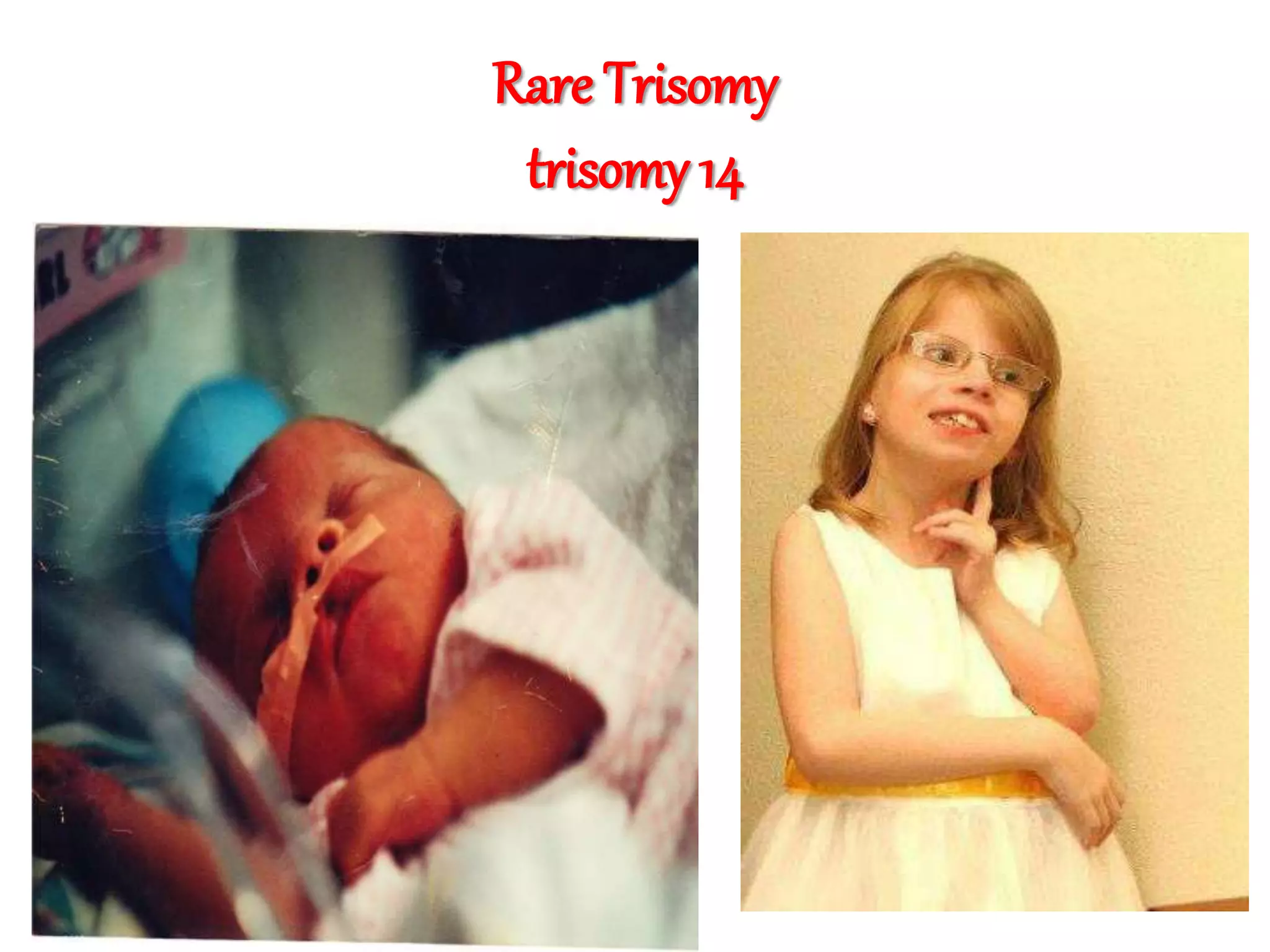 Rare Trisomy
trisomy 14
 