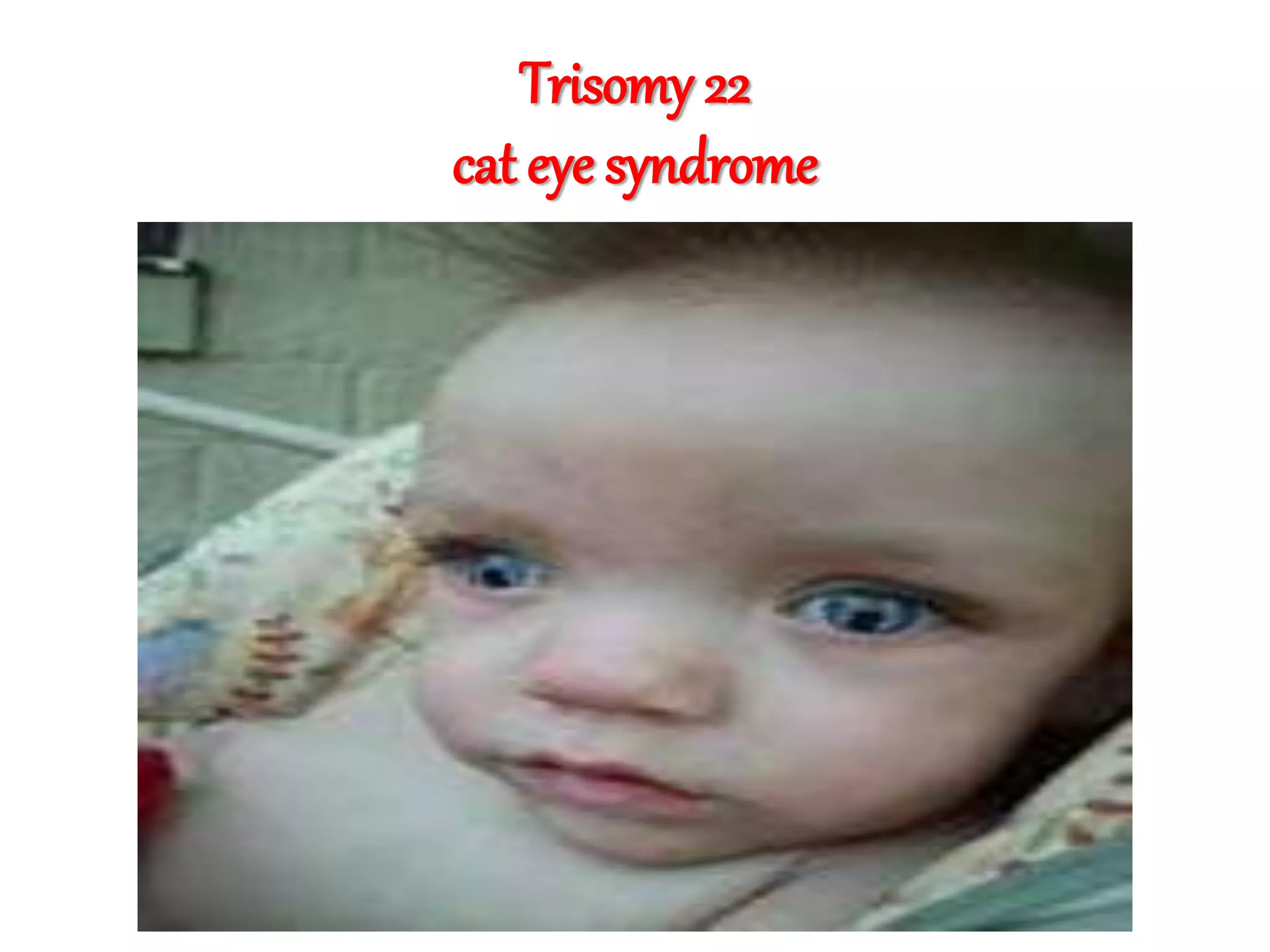 Trisomy 22
cat eye syndrome
 