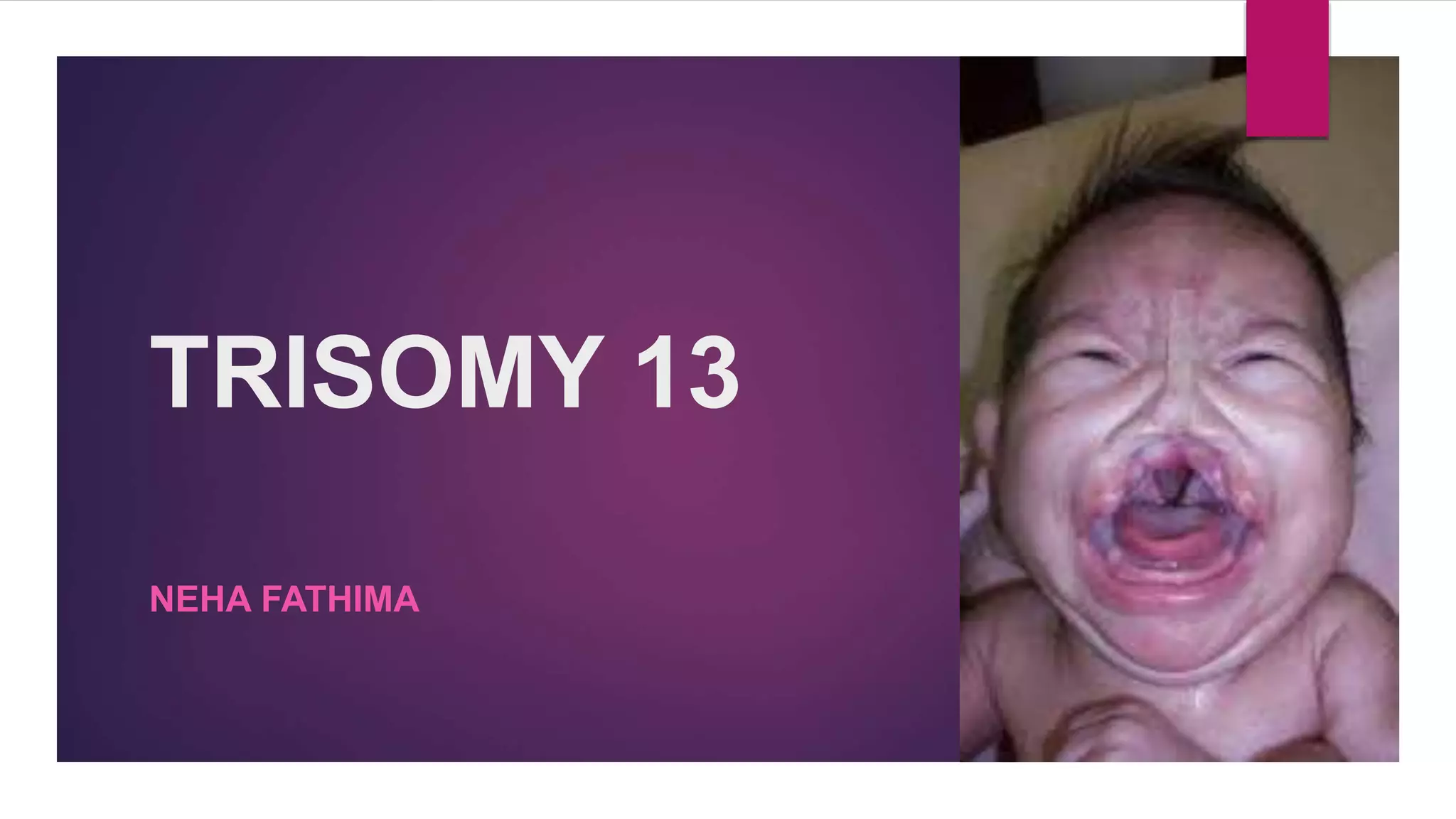 Trisomy 13 PPT