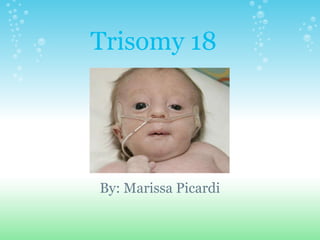 Trisomy 18 By: Marissa Picardi 