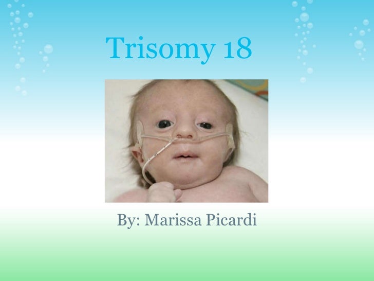 Trisomy 18