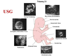 Trisomy21 | PPT