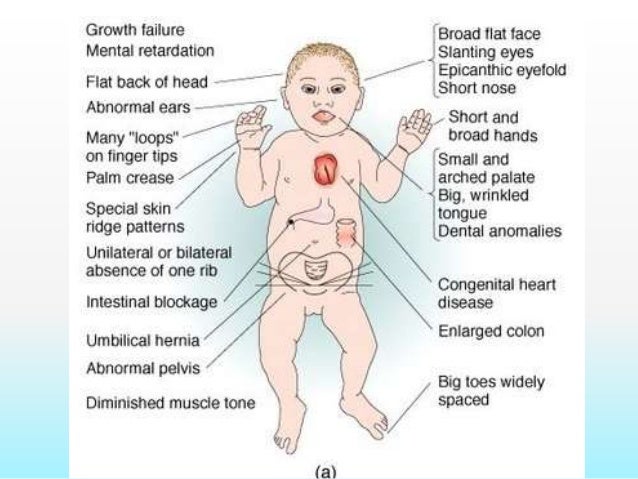 down syndrome features
