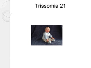 Trissomia 21
 