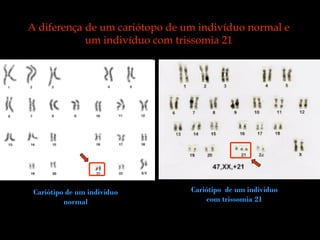 Trissomia21
