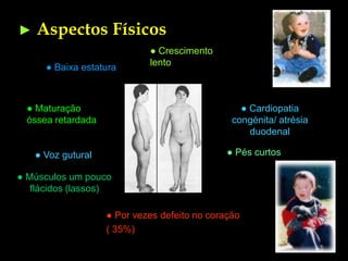 Trissomia21