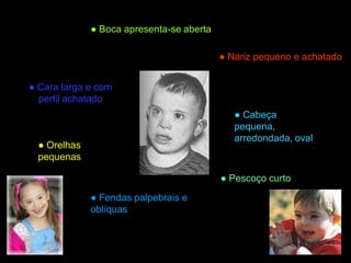 Trissomia21