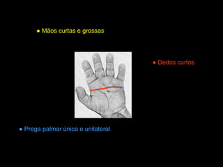 Trissomia21