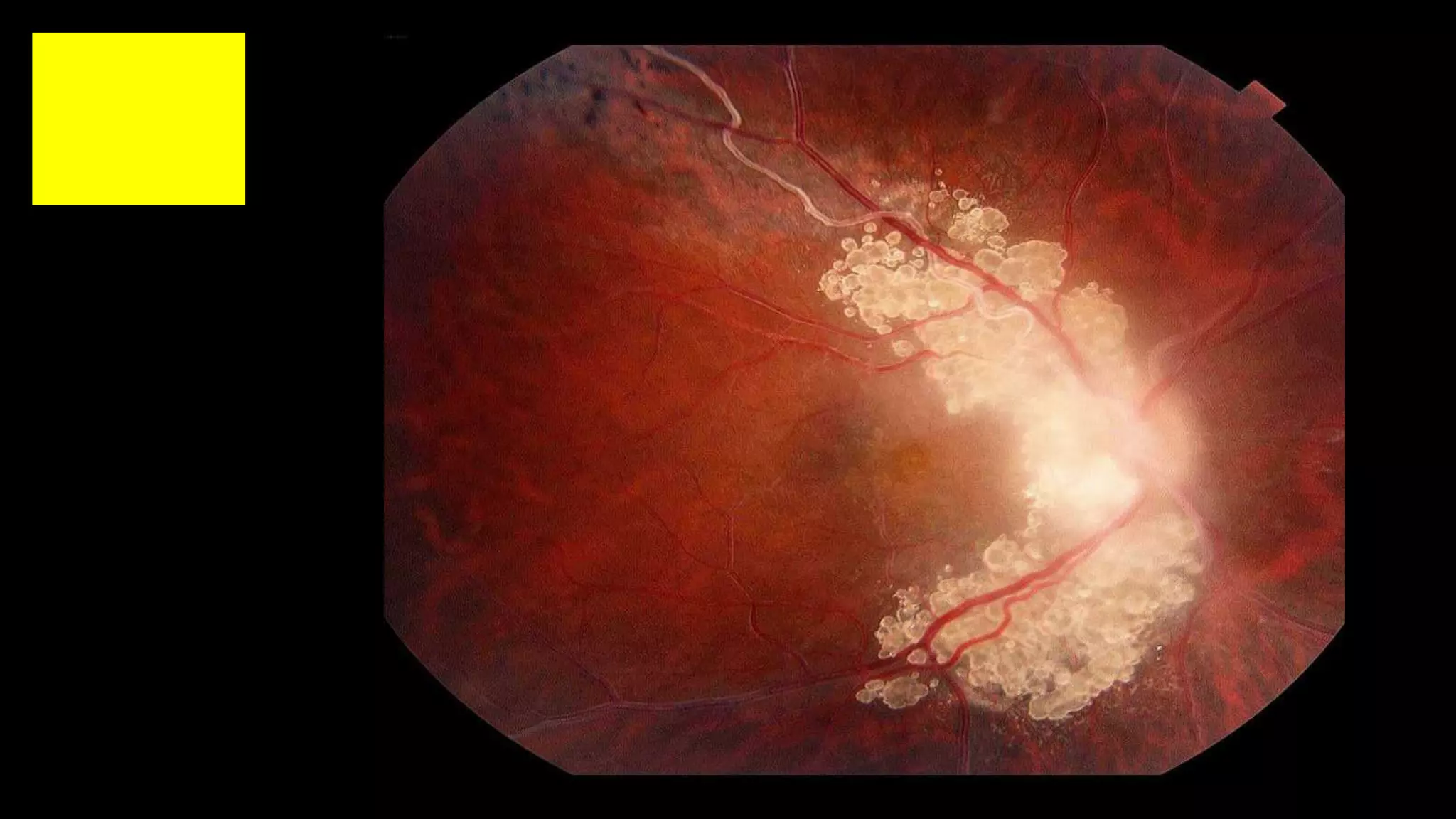 Ophthalmology Trivia - Feb 2020