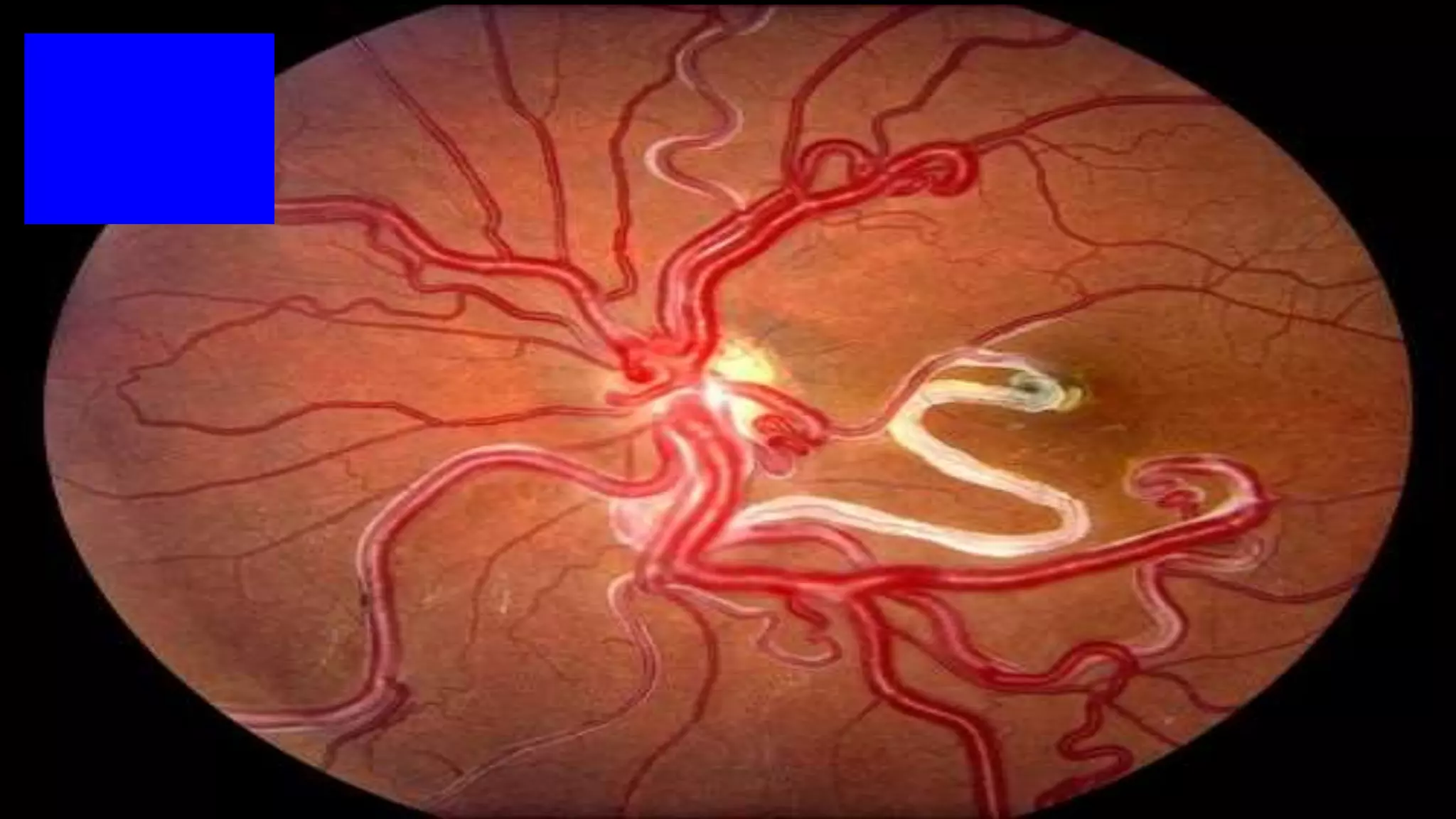 Ophthalmology Trivia - Feb 2020