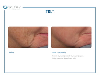 ®
The pro le of precision.

                               TRL™




Before                            After 1 treatment
                                  Perioral: 50µm(a)/50µm(c) x2; 50µm(a), single spot x1
                                  Photos courtesy of Nathen Rosen, M.D.
 