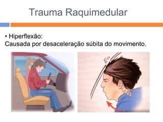 Trauma Raquimedular
• Hiperflexão:
Causada por desaceleração súbita do movimento.
 