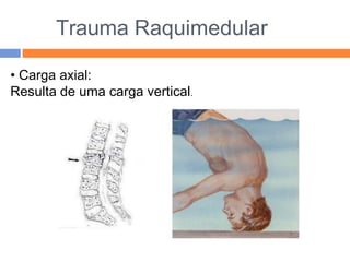 Trauma Raquimedular
• Carga axial:
Resulta de uma carga vertical.
 