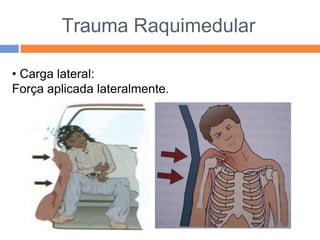 Trauma Raquimedular
• Carga lateral:
Força aplicada lateralmente.
 