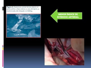 MENOR ÍNDICE DE
ESTENOSIS ARTERIAL

 