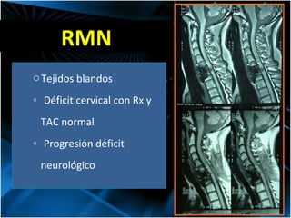 Tejidos blandos Déficit cervical con Rx y  TAC normal Progresión déficit  neurológico RMN 