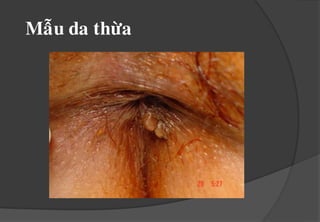 TRIEÄU CHÖÙNG CÔ NAÊNGTrieäuchöùngcônaêng:Chaûymaùu .