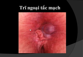 Sa buùitró : ñoä 3,4 thöôønggaâykhoùchòu