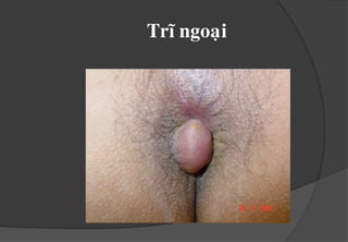 ngöùa do vieâmdaquanhhaäumoân