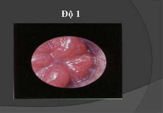 Ñau: khicoùkeømtheonöùthaäumoân, aùpxecaïnhhaäumoân, thuyeântaécmaïch, satróngheït .TOAØN THAÂNÑasoákhoângcoùtrieäuchöùngthieáumaùu