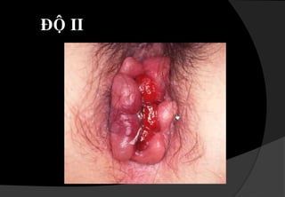 ThænhthoaûngcoùthieáumaùunaëngTRIEÄU CHÖÙNG THÖÏC THEÅNhìn:buùitró ,vuøngdaxungquanhhaäumoân, chaáttieát