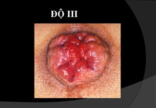 Sôø:sôønaénngoaøihaäumoân,buùichæmeàmaánxeïp