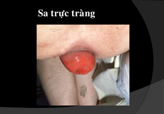  Naèm döôùi ñöôøng löôïc , ñöôïc phuû leân bôûi lôùp teá baøo vaåy .Maãu da thöøa