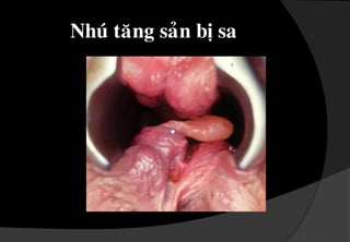 Naèmtreânñöôønglöôïc , ñöôïcphuûleânbôûilôùpcoätMorgagni.Trónoäichialaøm 4 ñoä :Ñoä 1 : naèmtrongoánghaäumoân.