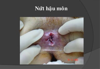 Ñoä 4 : sathöôøngxuyeânrangoaøi.Ñoä 1