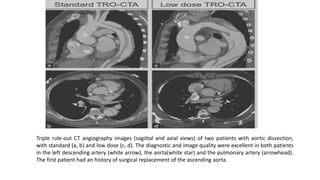 Pros
TRO CT can reduce
(a) time for patient triage,
(b) number of required diagnostic tests,
(c) costs, and
(d) radiation ...