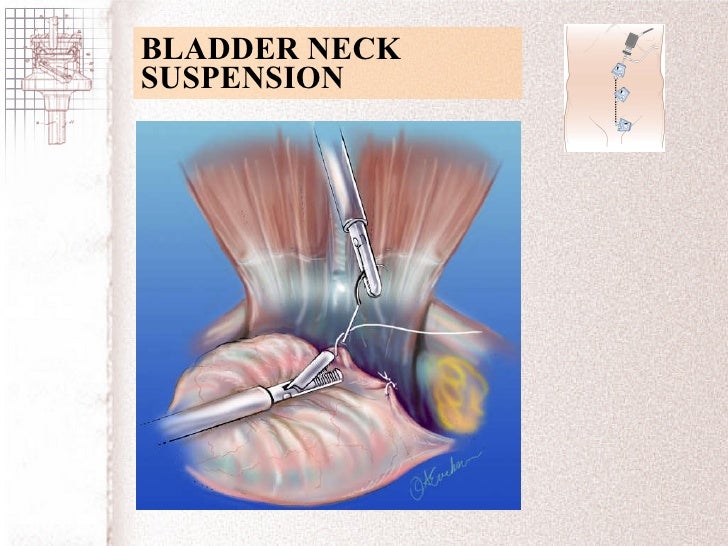 Trocar/Port Placement for the Procedure General Strategies