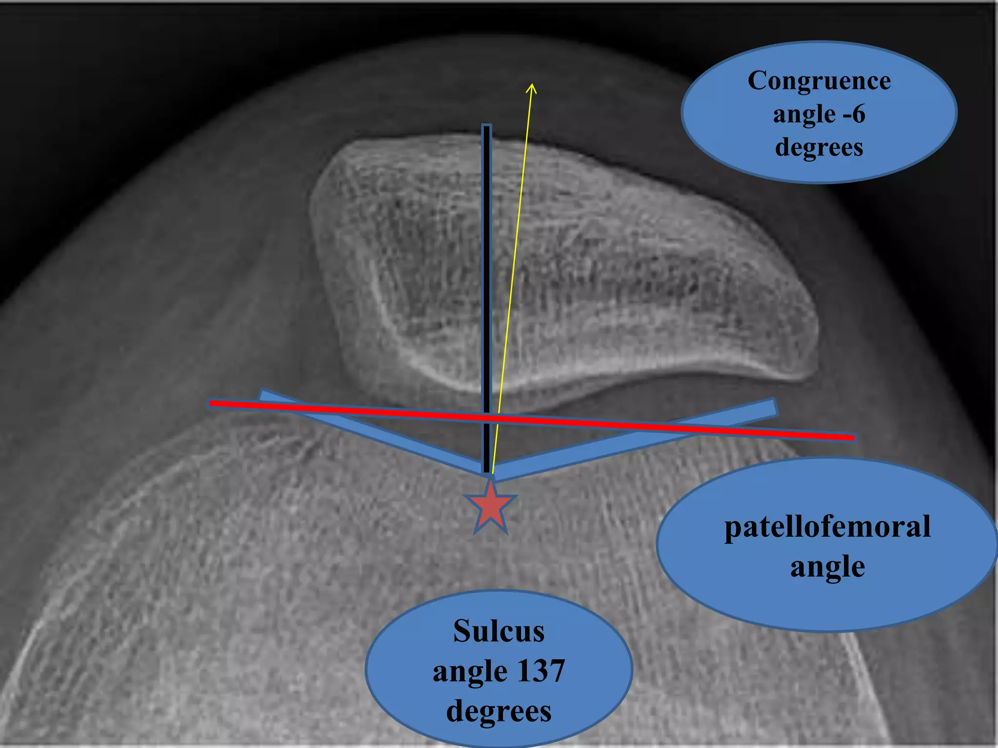 Congruence
angle -6
degrees
Sulcus
angle 137
degrees
patellofemoral
angle
 