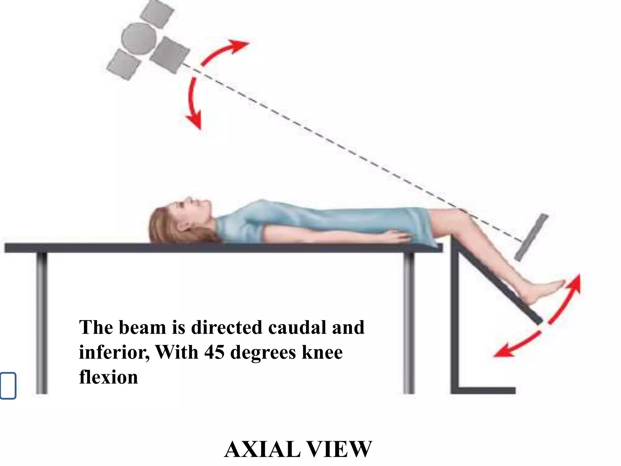 AXIAL VIEW
The beam is directed caudal and
inferior, With 45 degrees knee
flexion
 