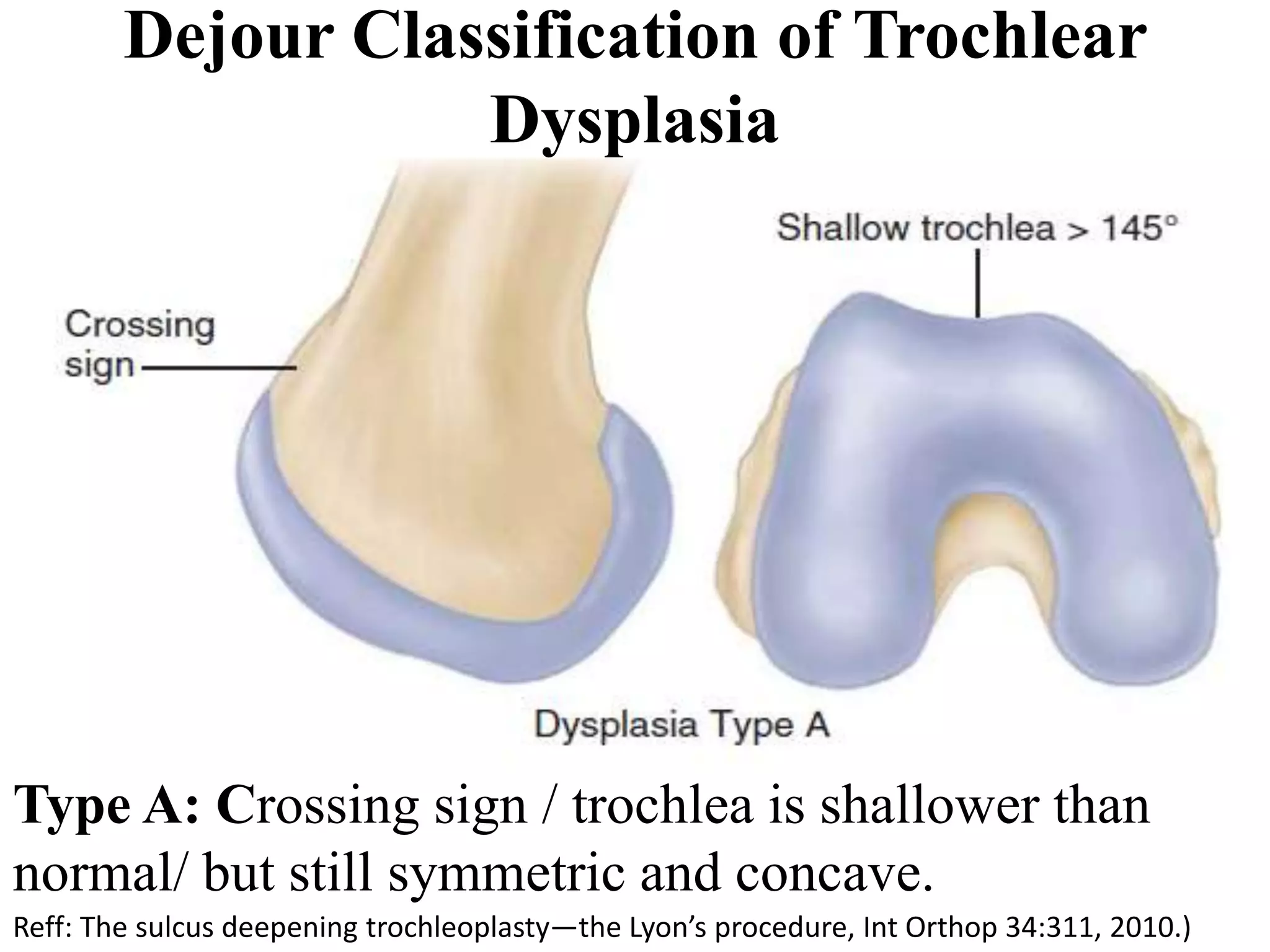 Dejour Classification of Trochlear
Dysplasia
Type A: Crossing sign / trochlea is shallower than
normal/ but still symmetric and concave.
Reff: The sulcus deepening trochleoplasty—the Lyon’s procedure, Int Orthop 34:311, 2010.)
 