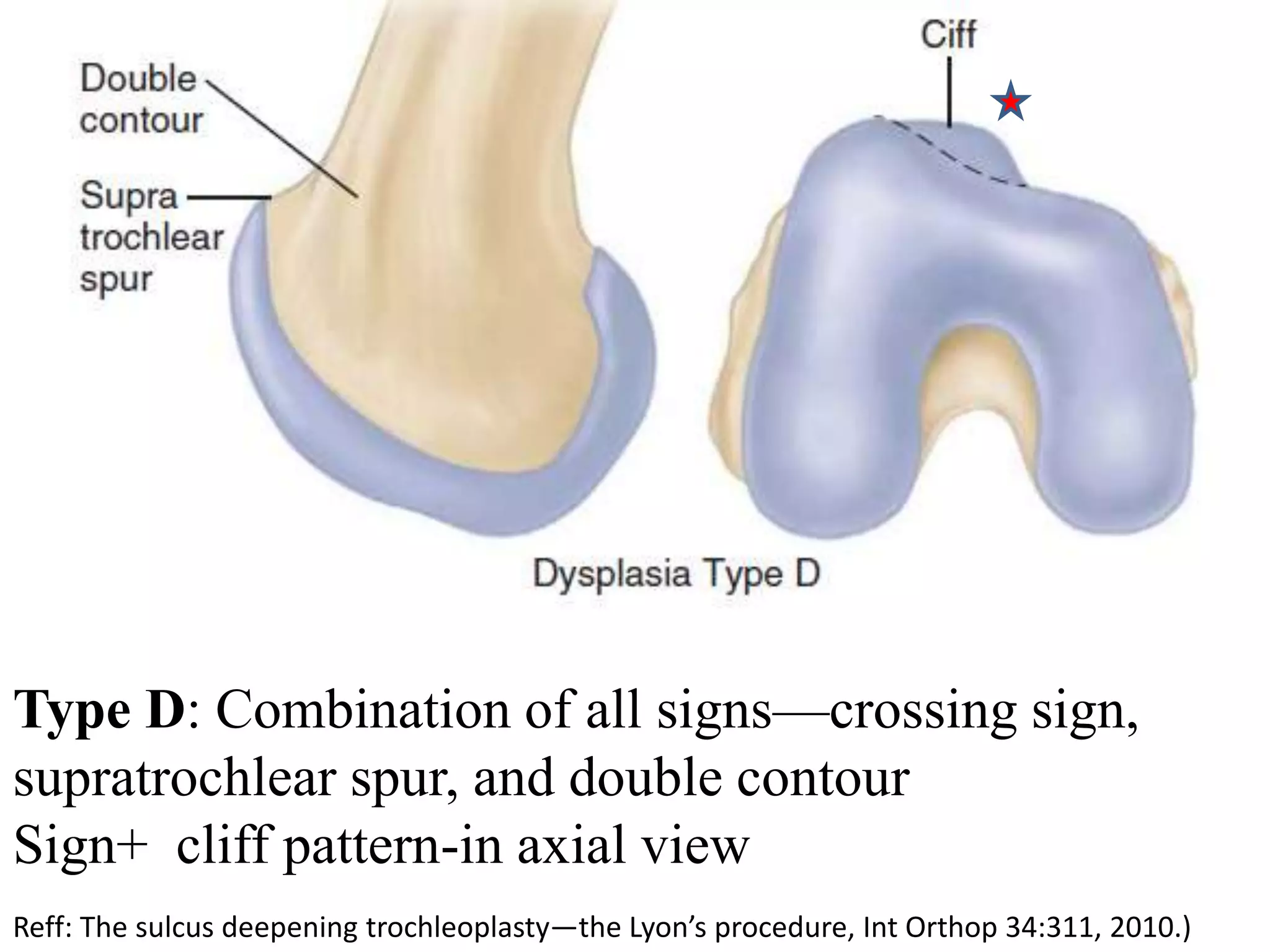 Type D: Combination of all signs—crossing sign,
supratrochlear spur, and double contour
Sign+ cliff pattern-in axial view
Reff: The sulcus deepening trochleoplasty—the Lyon’s procedure, Int Orthop 34:311, 2010.)
 