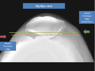 Trochlear dysplasia | PPTX