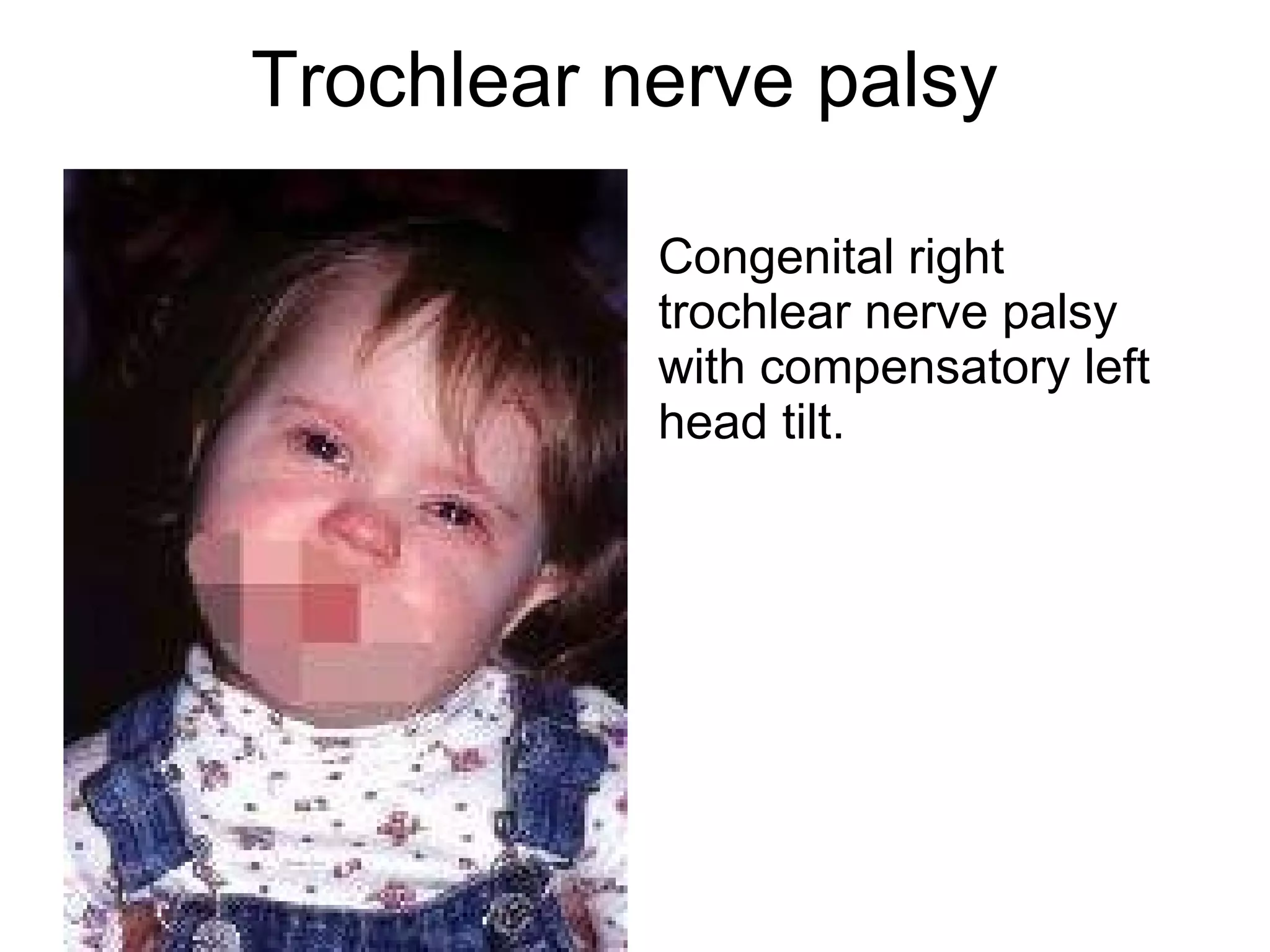 Trochlear nerve | PPT