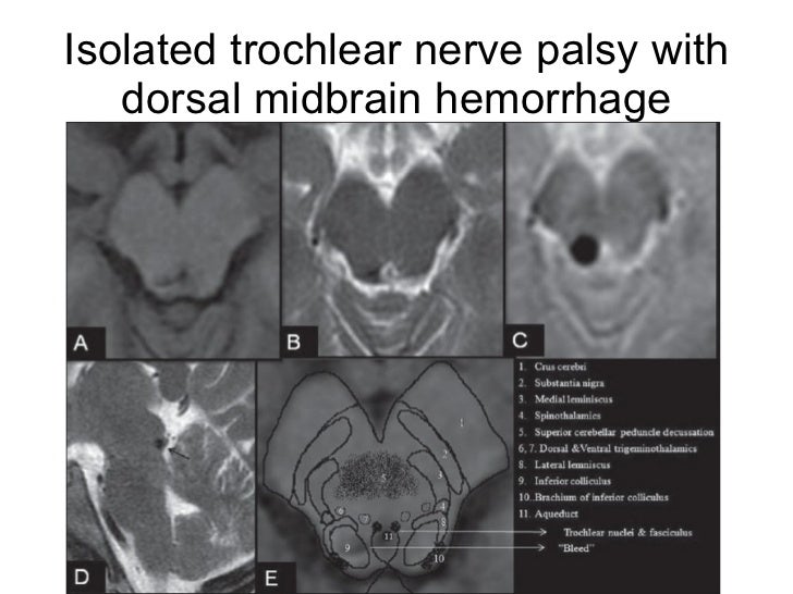Trochlear nerve