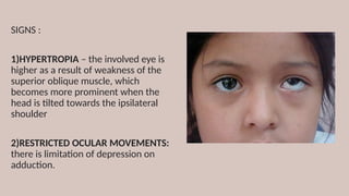 SIGNS :
1)HYPERTROPIA – the involved eye is
higher as a result of weakness of the
superior oblique muscle, which
becomes more prominent when the
head is tilted towards the ipsilateral
shoulder
2)RESTRICTED OCULAR MOVEMENTS:
there is limitation of depression on
adduction.
 