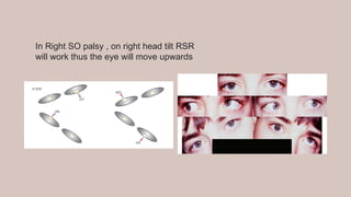 In Right SO palsy , on right head tilt RSR
will work thus the eye will move upwards
 