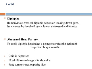 Trochlear nerve palsy- Quick review.pptx