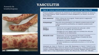 VASCULITIS
Ausencia de
trombocitopenia
 