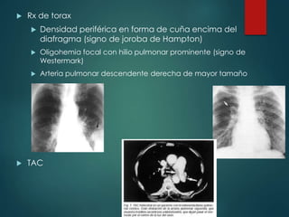  Rx de torax
 Densidad periférica en forma de cuña encima del
diafragma (signo de joroba de Hampton)
 Oligohemia focal con hilio pulmonar prominente (signo de
Westermark)
 Arteria pulmonar descendente derecha de mayor tamaño
 TAC
 