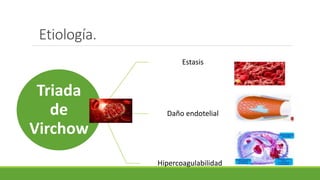 Etiología.
Triada
de
Virchow
Estasis
Daño endotelial
Hipercoagulabilidad
 
