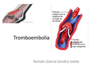 Tromboembolia



       Román García Sandra Ivette
 